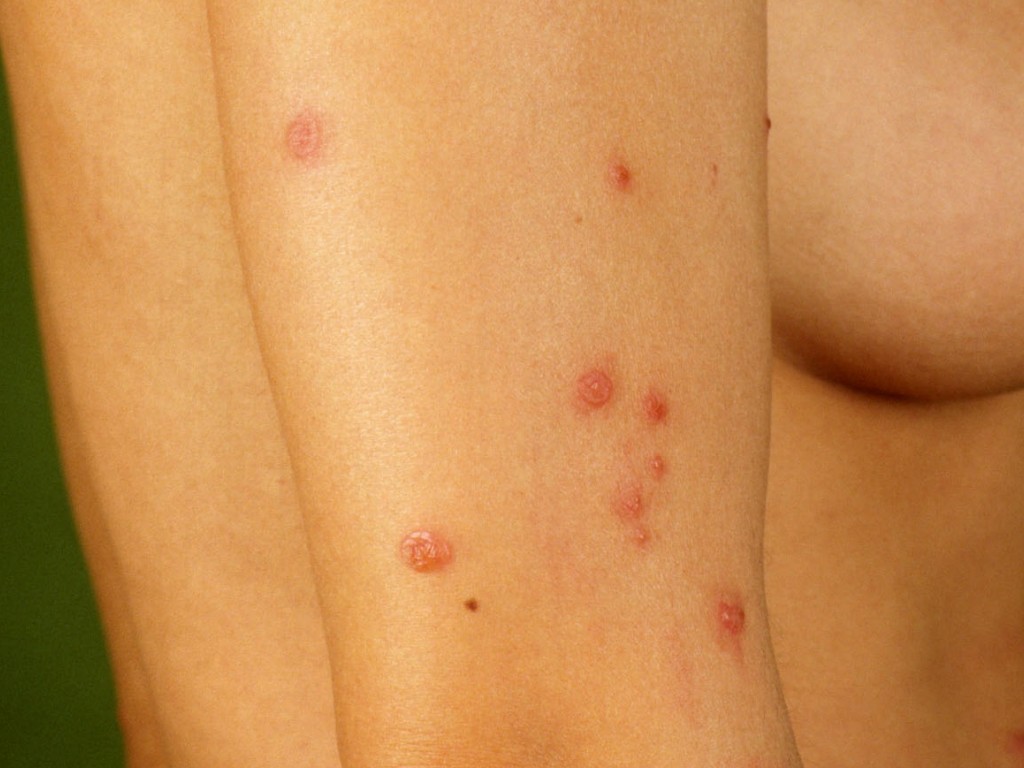 Persisterende insectenbeten - Papuleuze urticaria